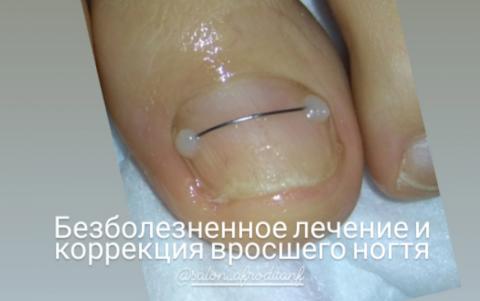 Афродита:  Коррекция вросшего ногтя (Титановая нить) в апреле 1500 руб.
