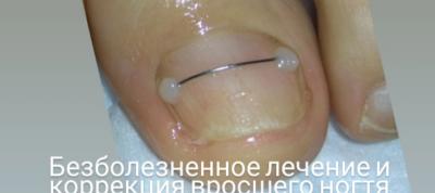Афродита:  Коррекция вросшего ногтя (Титановая нить) в апреле 1500 руб.