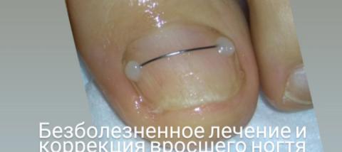 Афродита: Лечение вросшего ногтя (Титановая нить).